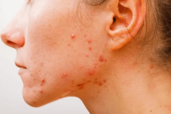 Acne Grau 1: Descubra dicas valiosas de como tratar